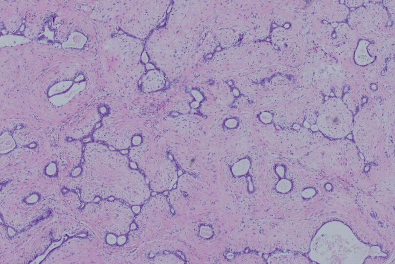 Solukuva fibroadenooma