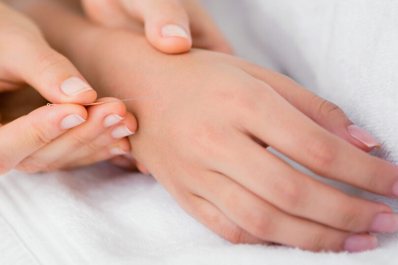 Terapeutti laittaa akupunktioneulaa naisen kämmenselkään.