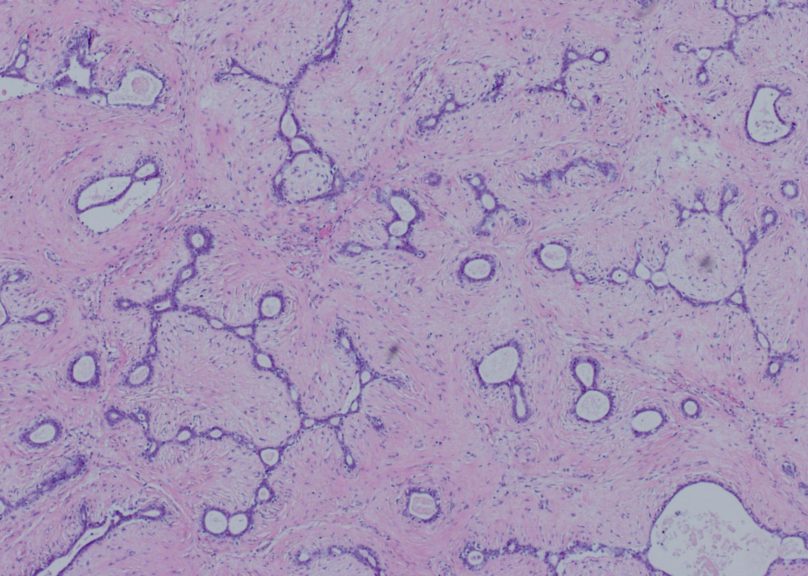 Solukuva fibroadenooma